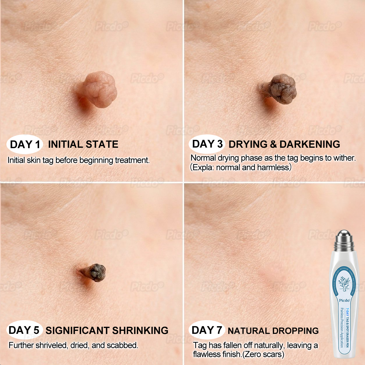 𝐏𝐈𝐂𝐃𝐎® ❼-𝗗𝗮𝘆 𝗧𝗮𝗴 & 𝗦𝗽𝗼𝘁 𝗘𝗿𝗮𝘀𝗲𝗿 (𝒁𝒆𝒓𝒐 𝑷𝒂𝒊𝒏, 𝒁𝒆𝒓𝒐 𝑺𝒄𝒂𝒓𝒔 𝑹𝒐𝒍𝒍𝒆𝒓𝒃𝒂𝒍𝒍)