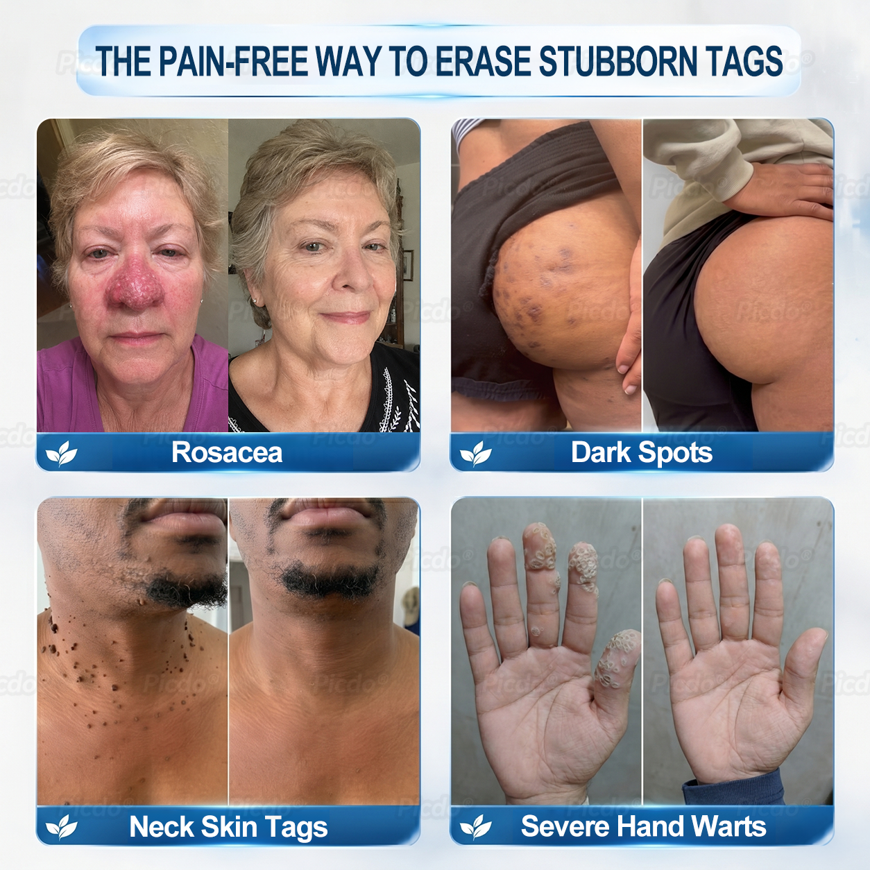 𝐏𝐈𝐂𝐃𝐎® ❼-𝗗𝗮𝘆 𝗧𝗮𝗴 & 𝗦𝗽𝗼𝘁 𝗘𝗿𝗮𝘀𝗲𝗿 (𝒁𝒆𝒓𝒐 𝑷𝒂𝒊𝒏, 𝒁𝒆𝒓𝒐 𝑺𝒄𝒂𝒓𝒔 𝑹𝒐𝒍𝒍𝒆𝒓𝒃𝒂𝒍𝒍)