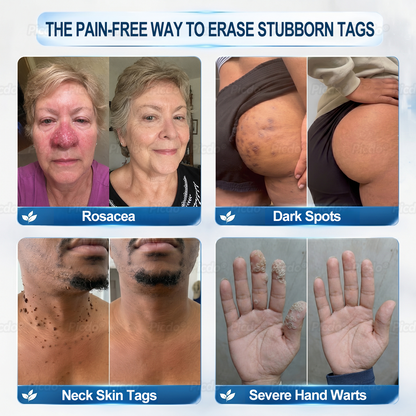 𝐏𝐈𝐂𝐃𝐎® ❼-𝗗𝗮𝘆 𝗧𝗮𝗴 & 𝗦𝗽𝗼𝘁 𝗘𝗿𝗮𝘀𝗲𝗿 (𝒁𝒆𝒓𝒐 𝑷𝒂𝒊𝒏, 𝒁𝒆𝒓𝒐 𝑺𝒄𝒂𝒓𝒔 𝑹𝒐𝒍𝒍𝒆𝒓𝒃𝒂𝒍𝒍)