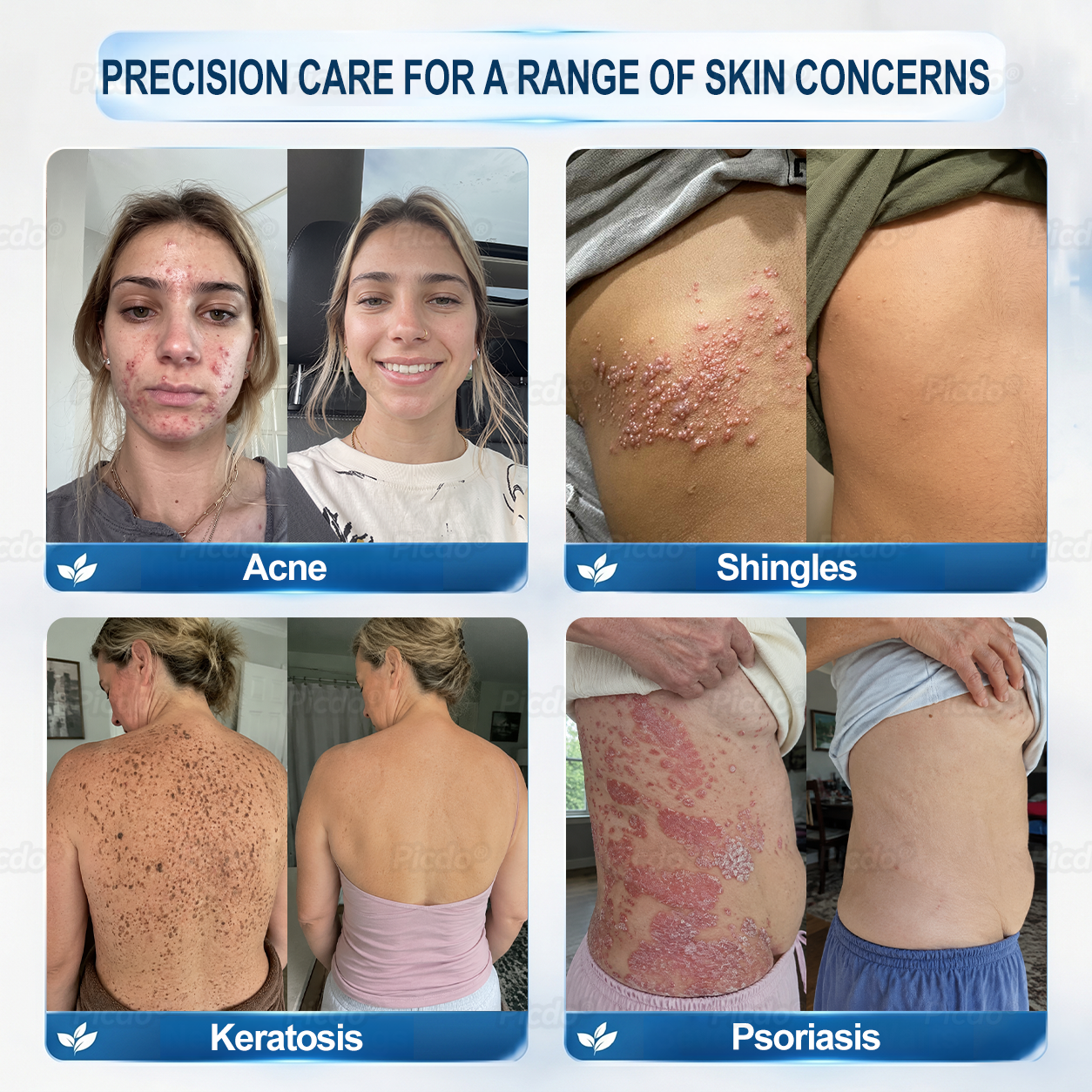 𝐏𝐈𝐂𝐃𝐎® ❼-𝗗𝗮𝘆 𝗧𝗮𝗴 & 𝗦𝗽𝗼𝘁 𝗘𝗿𝗮𝘀𝗲𝗿 (𝒁𝒆𝒓𝒐 𝑷𝒂𝒊𝒏, 𝒁𝒆𝒓𝒐 𝑺𝒄𝒂𝒓𝒔 𝑹𝒐𝒍𝒍𝒆𝒓𝒃𝒂𝒍𝒍)