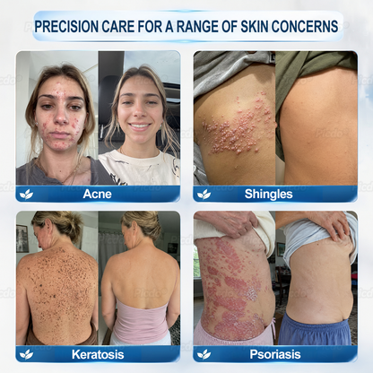 𝐏𝐈𝐂𝐃𝐎® ❼-𝗗𝗮𝘆 𝗧𝗮𝗴 & 𝗦𝗽𝗼𝘁 𝗘𝗿𝗮𝘀𝗲𝗿 (𝒁𝒆𝒓𝒐 𝑷𝒂𝒊𝒏, 𝒁𝒆𝒓𝒐 𝑺𝒄𝒂𝒓𝒔 𝑹𝒐𝒍𝒍𝒆𝒓𝒃𝒂𝒍𝒍)