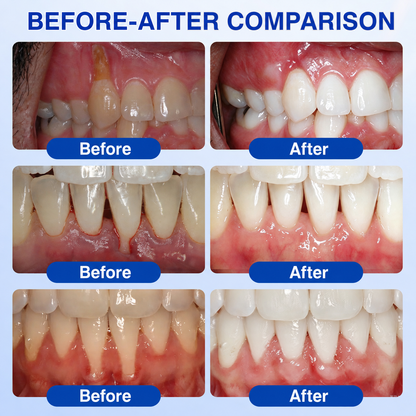 🦷𝑮𝒍𝒊𝒎𝒎𝒆𝒓𝒍𝒚®𝑮𝒖𝒎𝑹𝒆𝒗𝒊𝒗𝒆 𝑷𝒆𝒓𝒊𝒐𝒅𝒐𝒏𝒕𝒊𝒂 𝑹𝒂𝒑𝒂𝒊𝒓 𝑮𝒆𝒍
