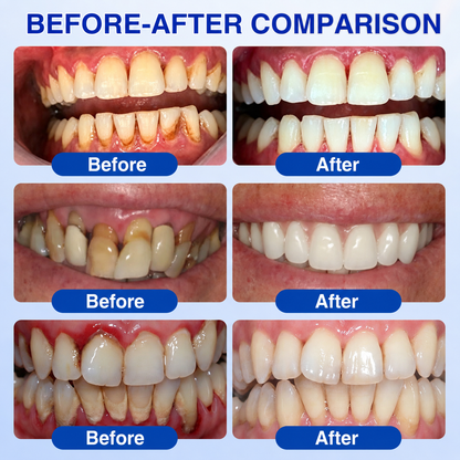 🦷𝑮𝒍𝒊𝒎𝒎𝒆𝒓𝒍𝒚®𝑮𝒖𝒎𝑹𝒆𝒗𝒊𝒗𝒆 𝑷𝒆𝒓𝒊𝒐𝒅𝒐𝒏𝒕𝒊𝒂 𝑹𝒂𝒑𝒂𝒊𝒓 𝑮𝒆𝒍